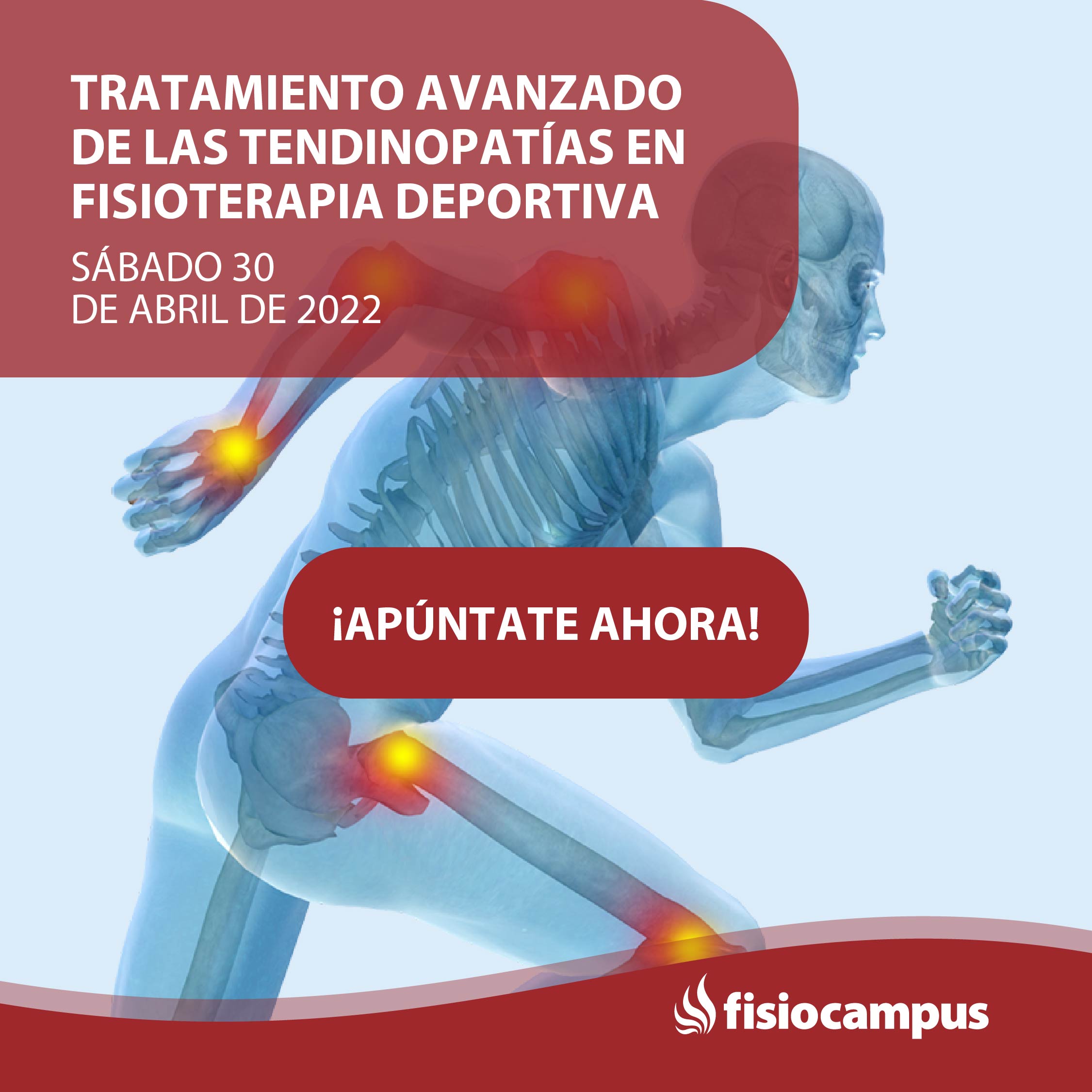 Tratamiento Avanzado De Las Tendinopat As En Fisioterapia Deportiva